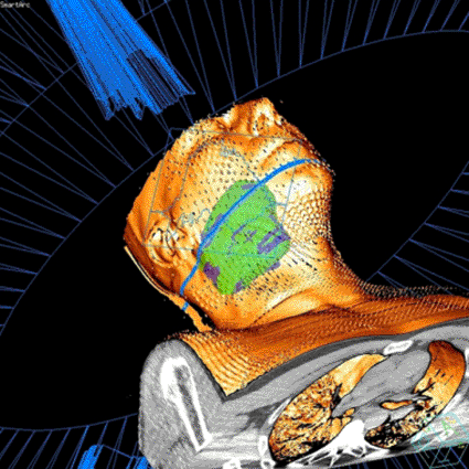 Image: SmartArc, a radiation treatment planning option designed for volumetric-modulated arc therapy (VMAT) that can be used with the leading linear accelerators on the market. Available as a module in Philips Pinnacle3 version 9 radiation treatment planning (RTP) software, the new planning option can be used with any VMAT-capable delivery system on the market (Photo courtesy of Royal Philips Electronics).